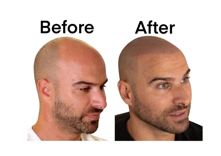 Tattoo Machine - Scalp Micro Pigmentation - Before & After 6